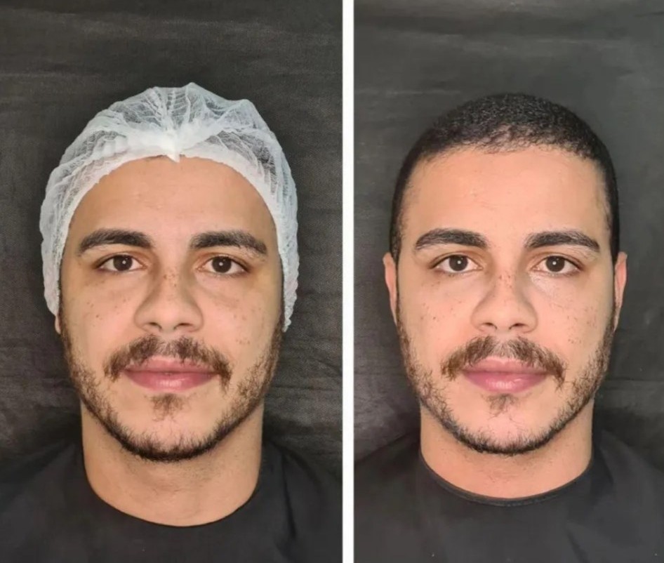 Antes e depois — harmonização facial, paciente 2