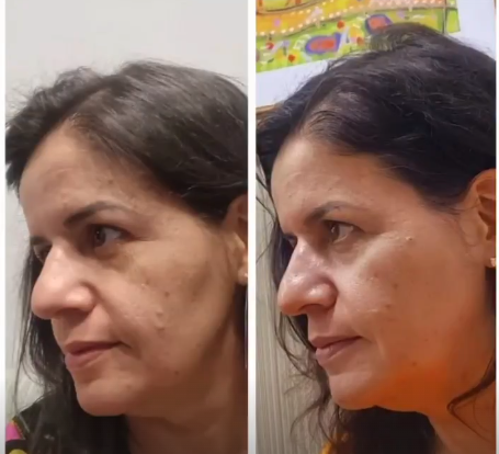 Antes e depois — harmonização facial, paciente 1