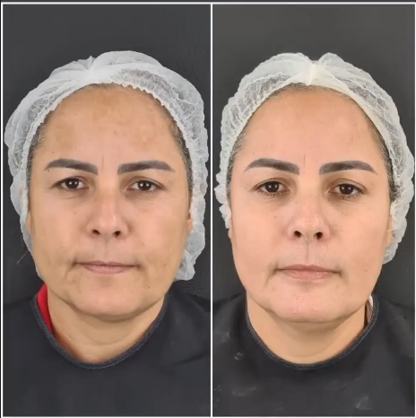 Antes e depois — harmonização facial, paciente 3